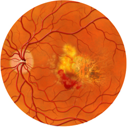 An-Eye-With-Wet-AMD